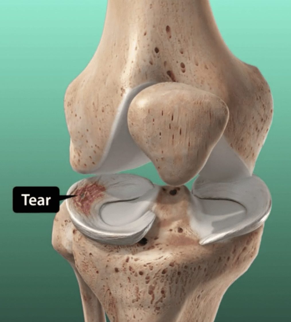 Meniscus Tears and How We Rehabilitate Them Using Physio